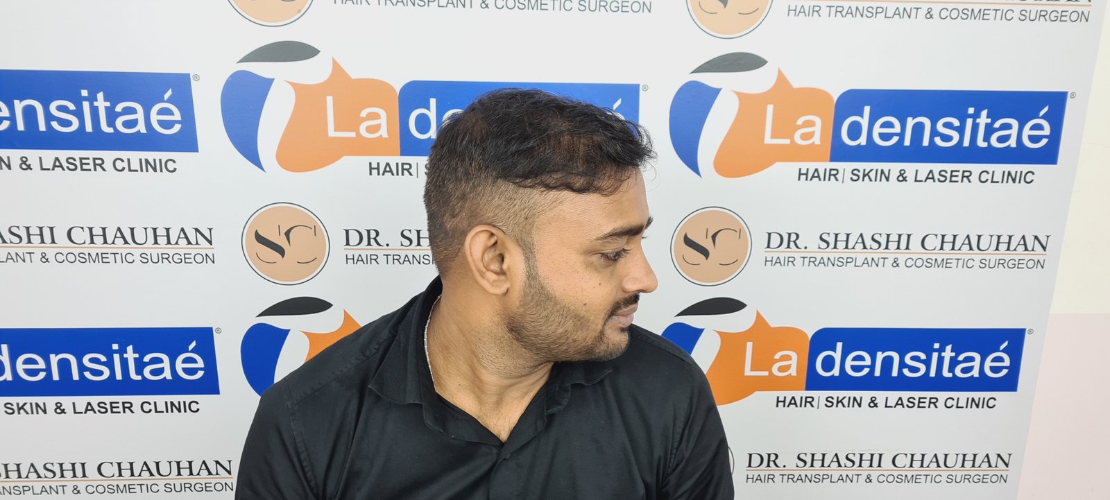 Abhay Pratap Yadav After Hair Transplant